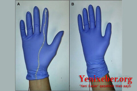 Создана "умная" перчатка, помогающая предотвратить осложнения при родах -